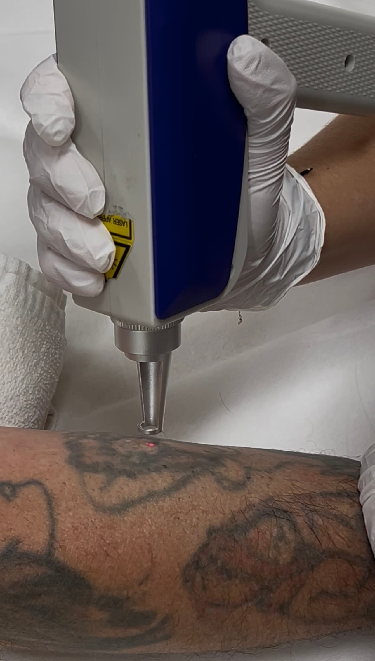 Laser Tattoo Removal